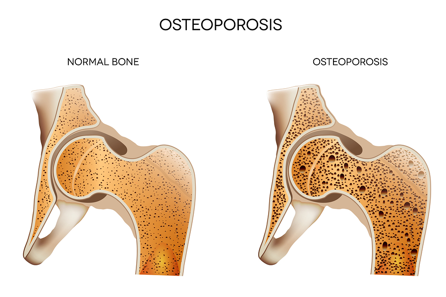 Caregiver in Braselton GA: Risk Factors For Osteoporosis